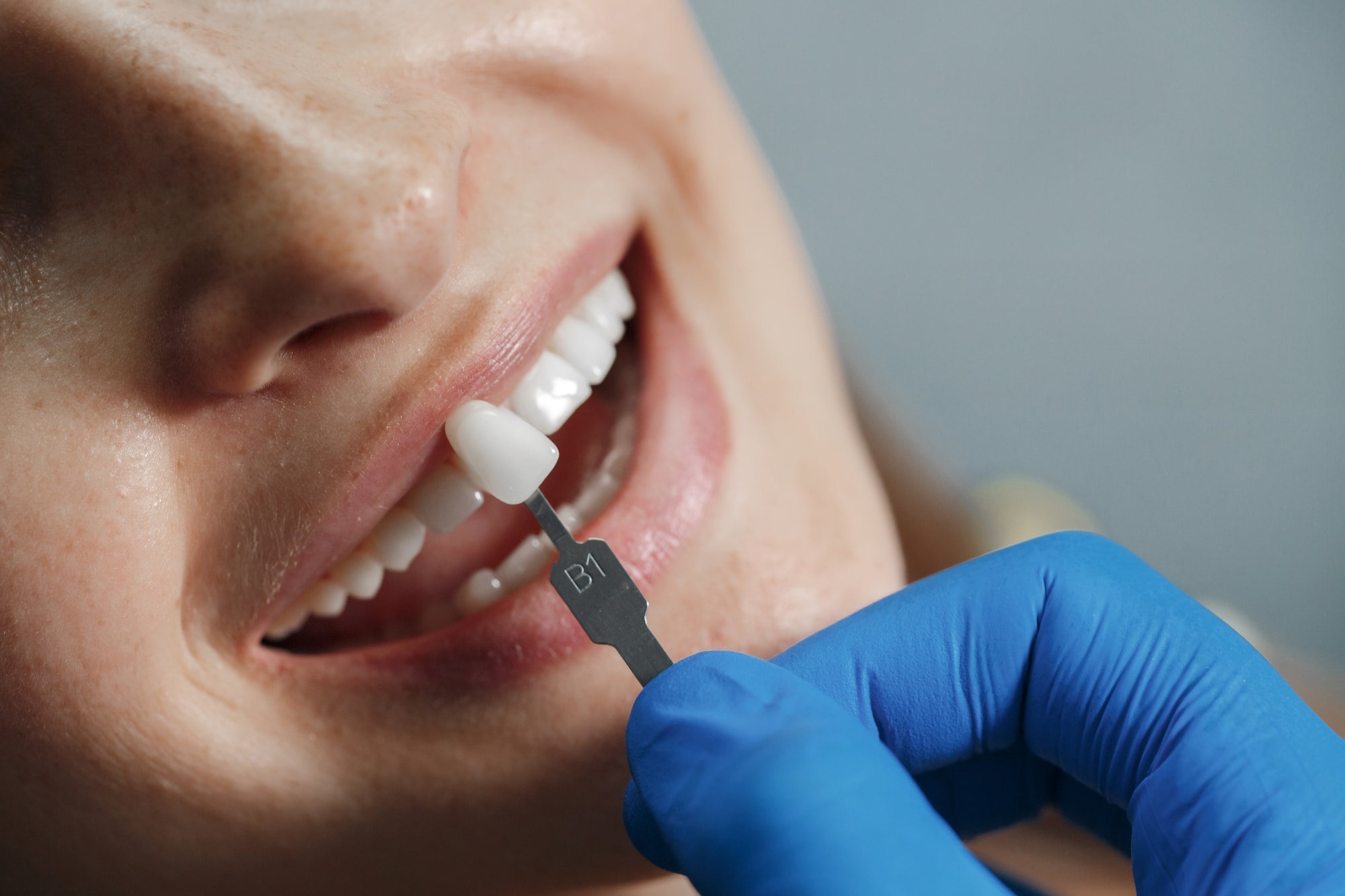 Tooth-Coloured Composite Restorations