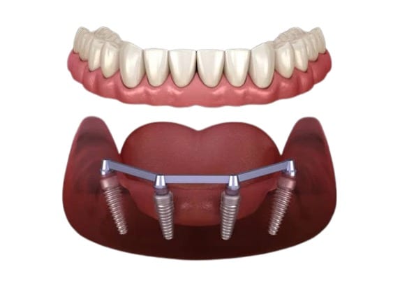 Multiple-Tooth Implant Rehabilitation