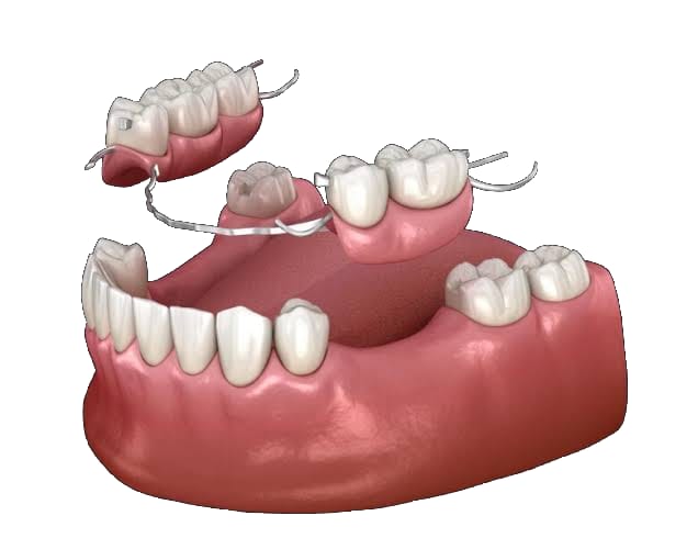 Removable Partial Dentures