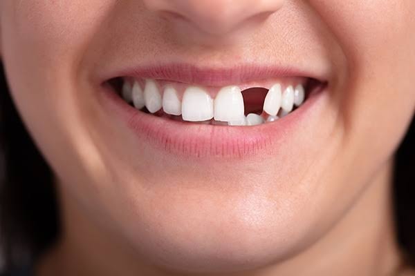 Replacement of Missing Teeth