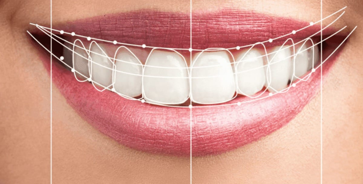 Smile Analysis & Smile Designing